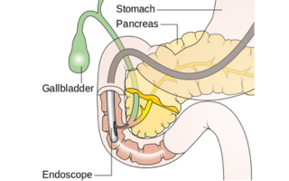 ERCP