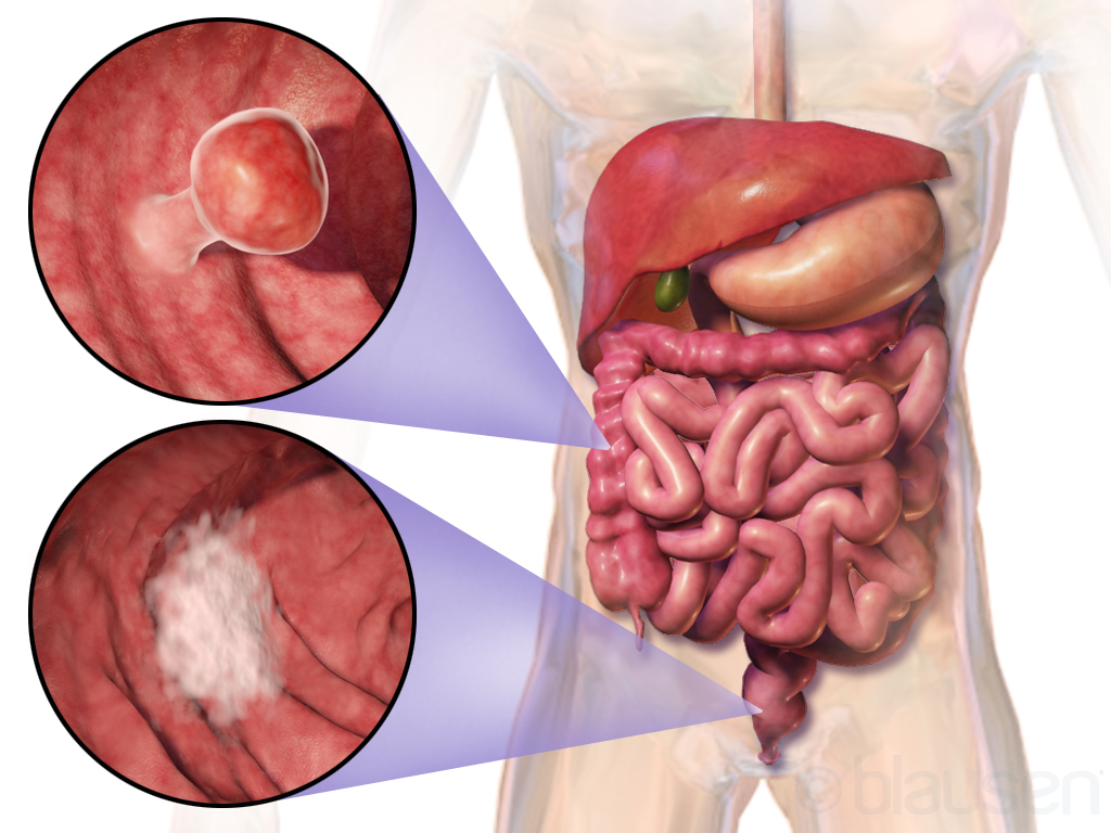 Intestine cancer illustration