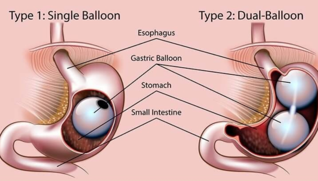 Gastro Balloon